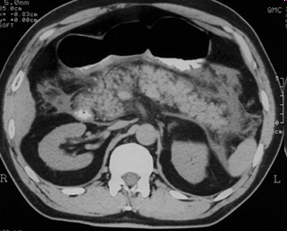CT of the pancreas in a dog with pancreatitis.